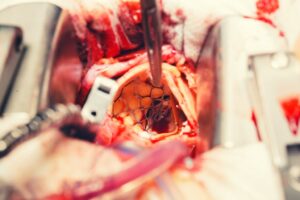 Revolutionizing Aortic Valve Treatment: Transcatheter Aortic Valve Replacement (TAVR)
