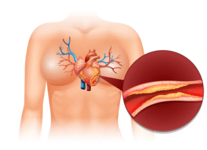Coronary Angioplasty: An Effective Treatment Option for Heart Diseases