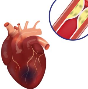 Know More About Coronary Artery Disease