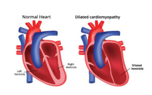 Understanding Cardiomyopathy