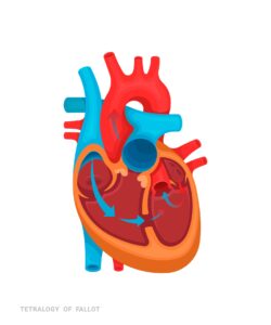Congenital Heart Disease: What is it?