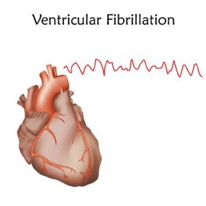 Ventricular Fibrillation: Understanding the Deadly Heart Rhythm
