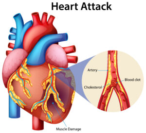 Importance of Early Heart Attack Treatment: Why Every Minute Matters