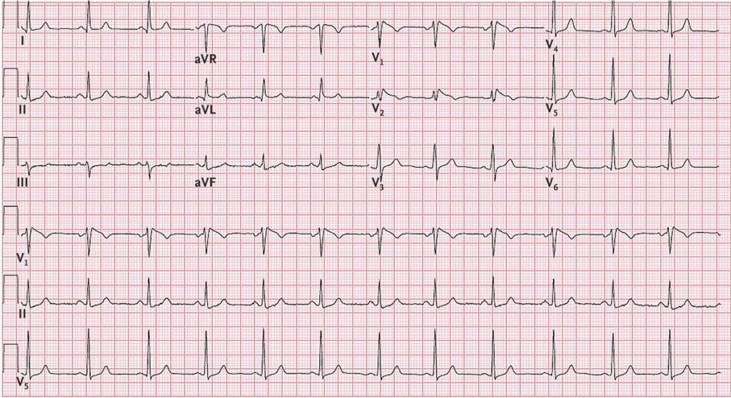 ECG