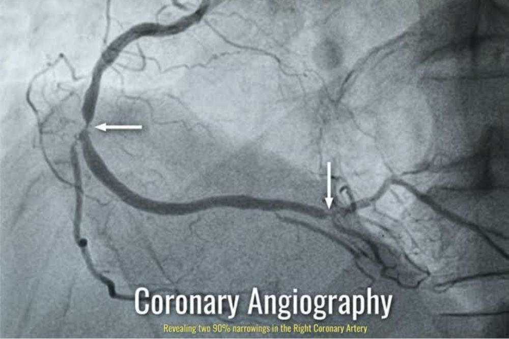 Corinary Angiography